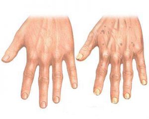 Hand_aging